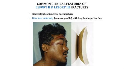 LEFORT FRACTURES.pptx