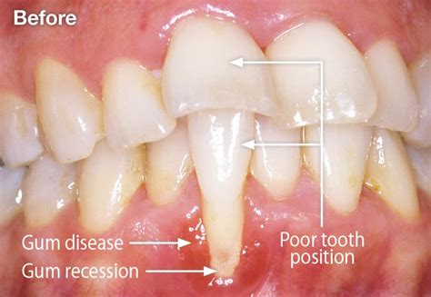 Tooth Recession 的图像结果