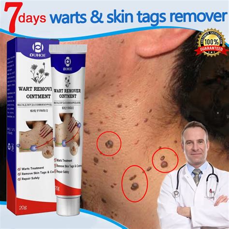 wart removal skin tag removal wart cream Wart Removal Ointment cream ...