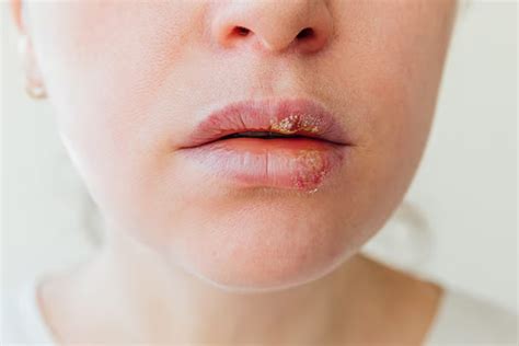 Lip Cancer Risks: Oncologist Reveals Key Insights | Herzindagi