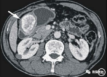 胃间质瘤和胃神经鞘瘤丨CT鉴别诊断