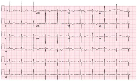 Sudden Cardiac Arrest in an Adult with Anomalous Origin of the Left ...