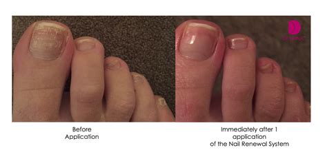Why Do My Toenails Turn White After Wearing Nail Polish at Alexander ...