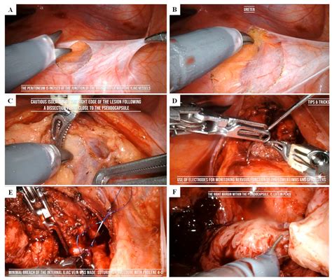 3D Model-Guided Robot-Assisted Giant Presacral Ganglioneuroma Exeresis ...