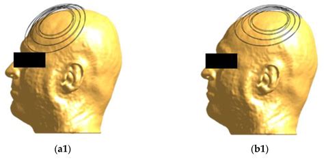 Electric Field Distribution Induced by TMS: Differences Due to ...