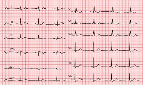 [Cardio-FR] Mobitz type 2 second degree A-V block, 2:1 conduction ...