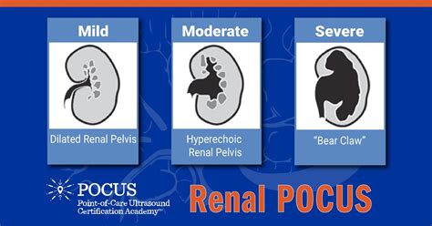 Renal POCUS: Look For Evidence Of Hydronephrosis! | POCUS Resources ...