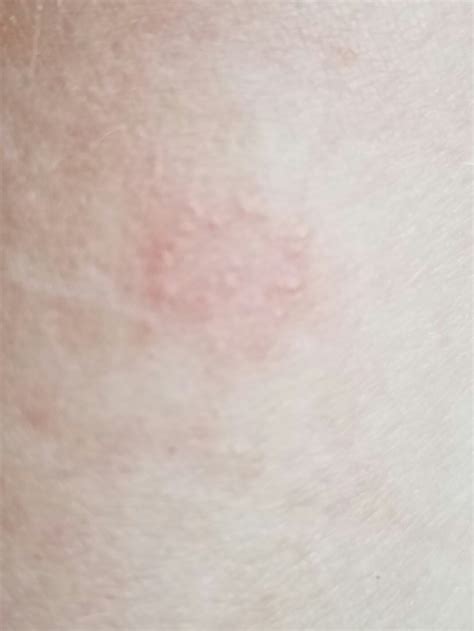 Beginning Stage Of Ringworm In Humans
