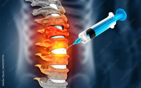 Image result for Lumbar Disc Injection