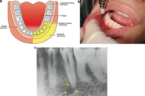 Extraoral Technique of Local Anesthesia 的图像结果