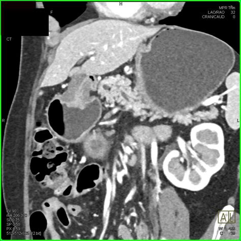 Subtle Pancreatic Cancer with Dilated Pancreatic Duct - Pancreas ...