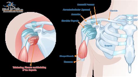 Is Frozen Shoulder a Symptom of Menopause? - Paul Kiritsis, MD ...