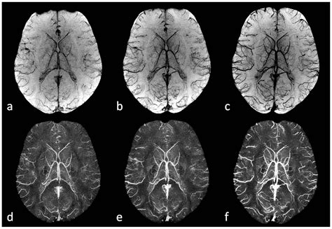 Susceptibility Weighted Imaging: Current Status and Future Directions | SpinTech MRI