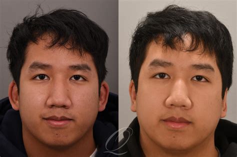 Otoplasty (Ear Pinning) Before & After Photos Patient 1001587 | Serving Rochester, Syracuse ...