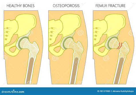 Osteoporosis1_with Femur Fracture and Dislocation Stock Vector ...