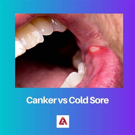 Cold Sore Versus Canker