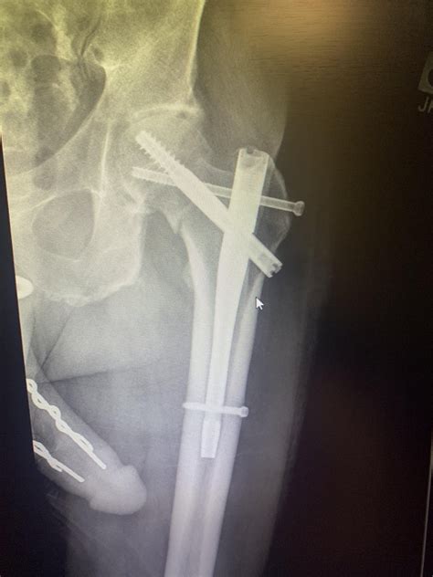 Routine Hip Xray : r/Radiology