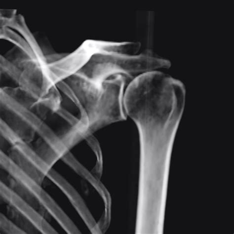 Shoulder X-ray Classification | Kaggle