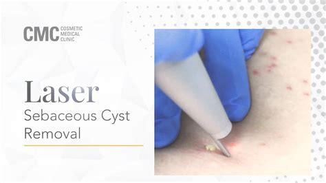 Image result for Sebaceous Cyst Removal Procedure