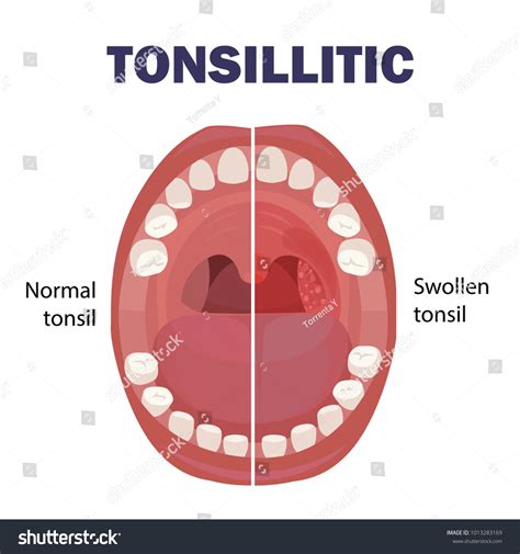 Normal Tonsil