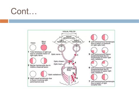 Image result for Visual Pathway Defects