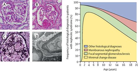 Uncovering The Primary Causes Of Nephritic Syndrome