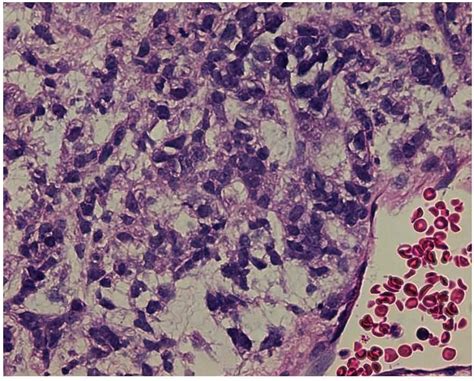 NUT Midline Carcinoma: Morphoproteomic Characterization with Genomic and Therapeutic Correlates