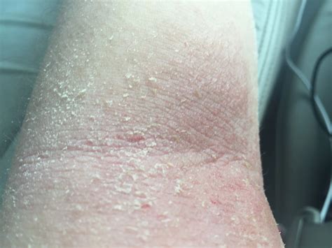 Dermatitis During Pregnancy