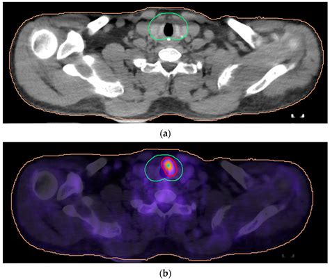 18F-FDG PET-CT- vs. CT-Based Radiotherapy Treatment Planning for Head and Neck Cancer