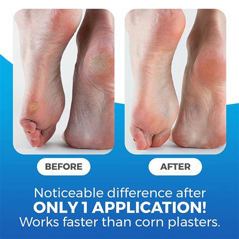 Foot Callus Remover with Salicylic Acid - Extra Strength Corn Remover ...