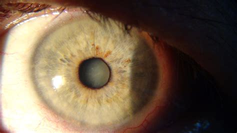 CATARATA | ALEXANDER OSPINO ACEVEDO Oftalmologo Retinologo ...