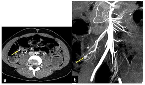 The Role of CT-Angiography in the Acute Gastrointestinal Bleeding: A Pictorial Essay of Active ...