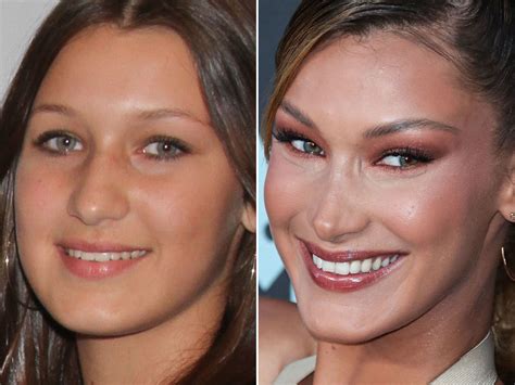 Bella Hadid Before Face Surgery