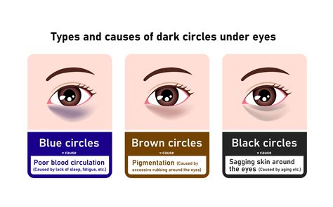 Conquering Those Under-Eye Blues: A Guide to Treating Dark Circles and Puffiness — Morganna's ...