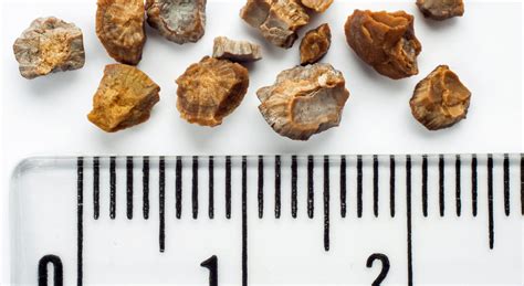 Stone Corner: Kidney Stone Risk Factors & Prevention | WakeMed Voices Blog