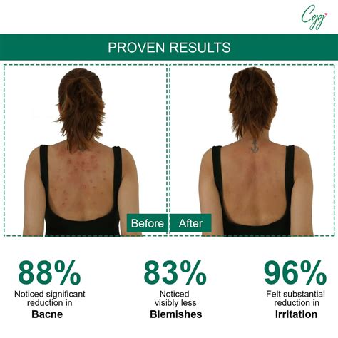 Buy CGG COSMETICS SALICYLIC ACID BODY ACNE SPRAY | 100 ML Online & Get ...