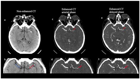 Correlation between Thrombus Perviousness and Distal Embolization during Mechanical Thrombectomy ...