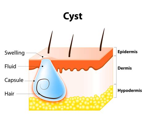 Infected Cyst