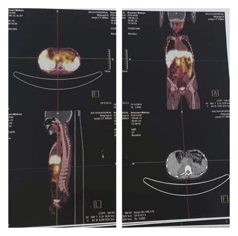 Image result for DOTA-TATE Scan