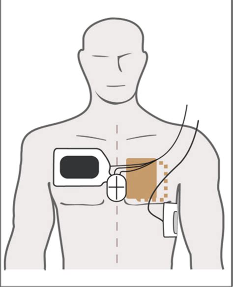 Reply to: streamlining defibrillation for refractory ventricular fibrillation - Resuscitation