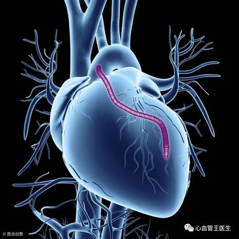 心脏最常见的这6种手术，有什么不一样，医生大白话一次讲清楚！|冠心病|医生|手术|心脏|支架|药物|-健康界