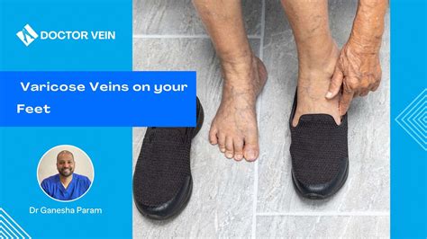 Bulging veins on feet