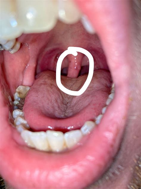 Bumps inside of cheek : r/askdentists