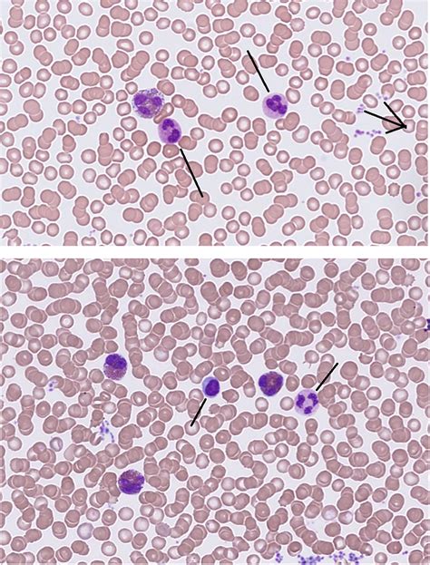 What Is Abs Eosinophil In Blood Test at Melody Wilson blog