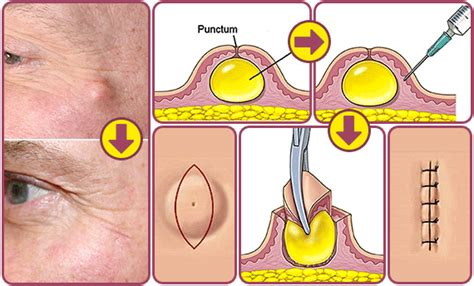 Image result for Sebaceous Cyst Removal Procedure