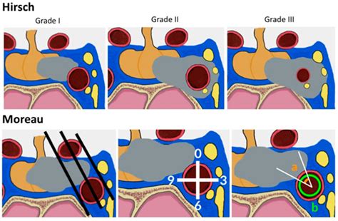 Pituitary Adenomas and Invasiveness from Anatomo-Surgical, Radiological ...