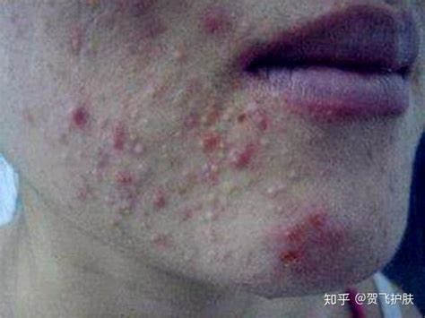 【嘴唇周围长痘痘是什么原因】【图】嘴唇周围长痘痘是什么原因？ 4个根因提醒你们_伊秀健康|yxlady.com