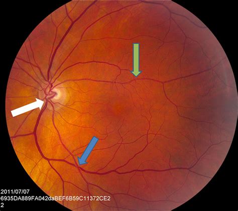 Retinal Vasculature | Hypertension