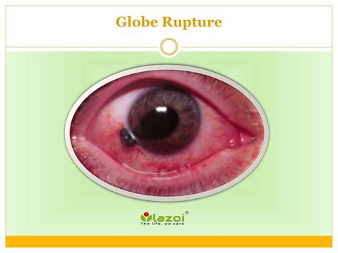 PPT - Globe Rupture PowerPoint Presentation, free download - ID:7955512