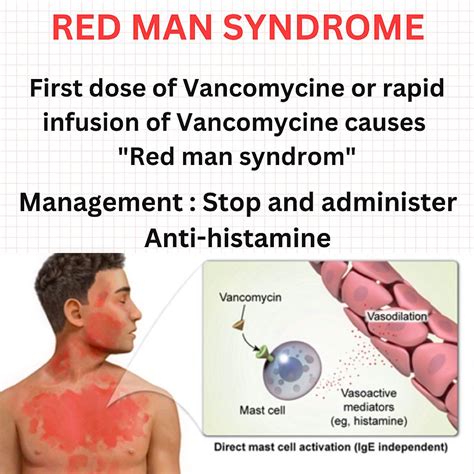 Red man syndrome For mild reactions (eg, flushing that is not ...